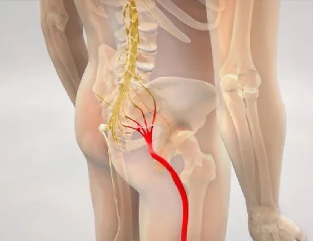 Dolor Ciático: Qué es y Cómo Controlarlo