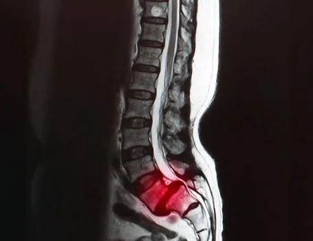Entendiendo la Espondilolistesis: Información para Pacientes