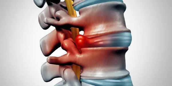 Herniated Disc