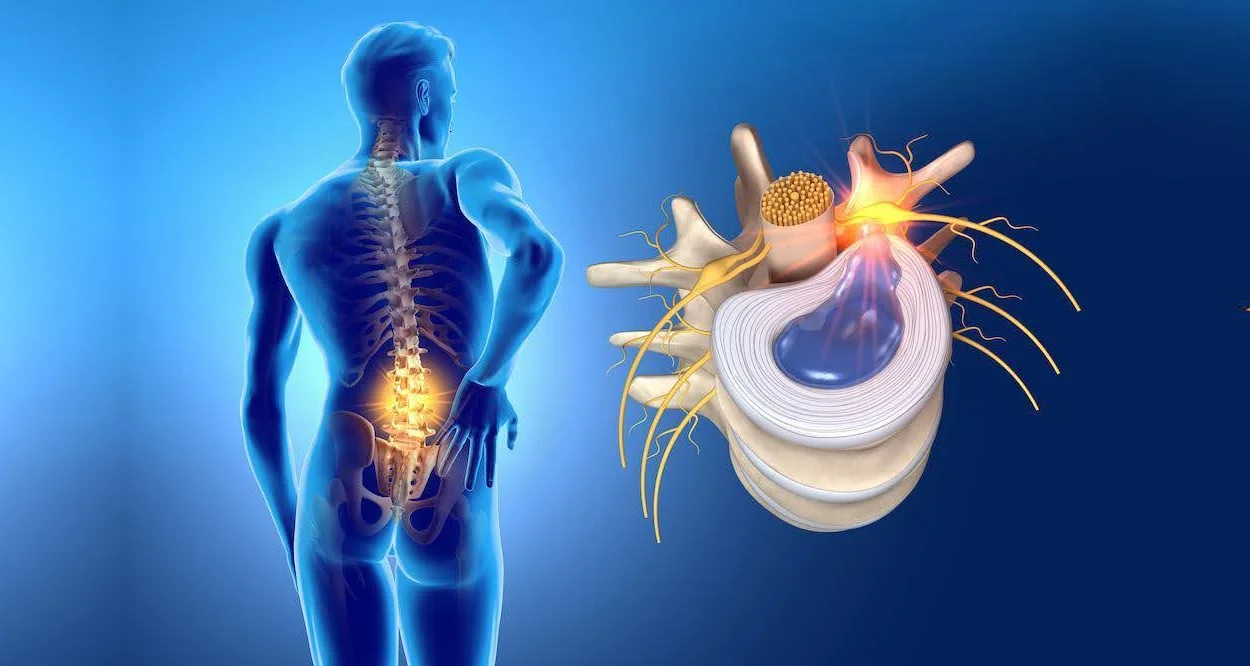 Hernia de Disco: Qué es y Cómo Afecta Tu Salud
