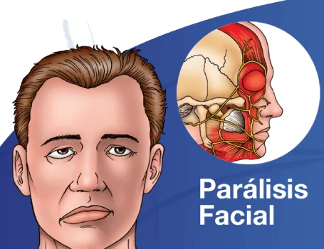Entendiendo la Parálisis Facial: Una Perspectiva Neuroquirúrgica