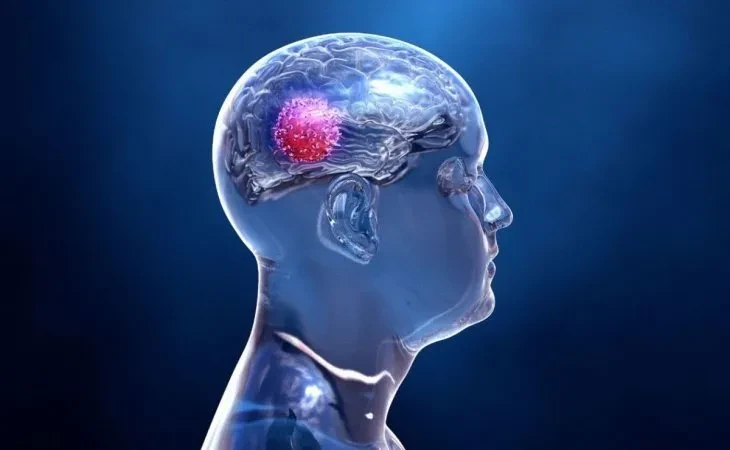 Tumores cerebrales