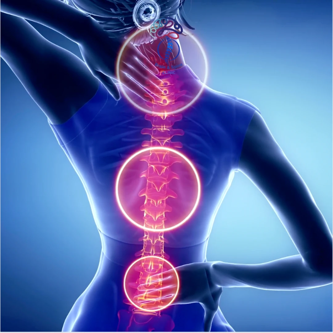 Hernias