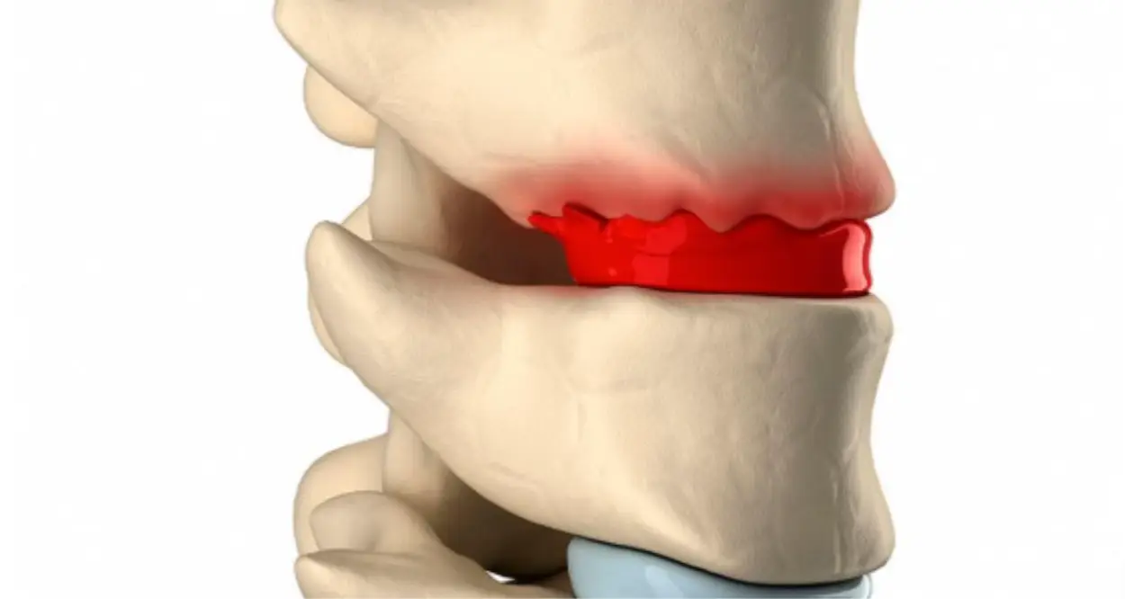 Enfermedad del Disco Intervertebral: Causas, Síntomas y Soluciones