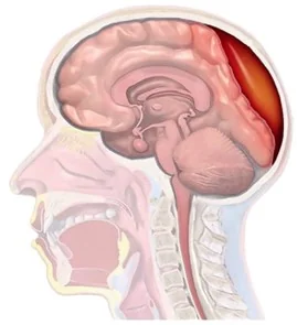 Hematoma Subdural: Lo que Necesitas Saber