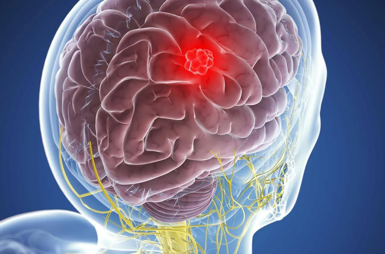 Meningioma: Una Guía para Pacientes